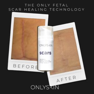 SCARS by ONLYSKIN has been clinically tested & proven to eliminate all old & new scars resulting from surgeries, C-sections, burns, cosmetic procedures, aesthetic treatments, acne, stretch marks, sun burns & even large traumatic scars on both face & body.